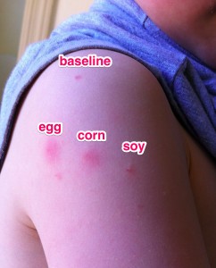 soy-corn-egg-allergy-reactions